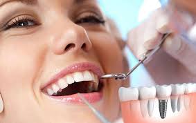 Implantes dentales